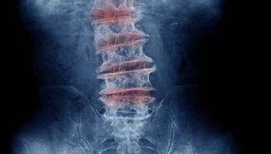 脊柱退行性疾病的x线片